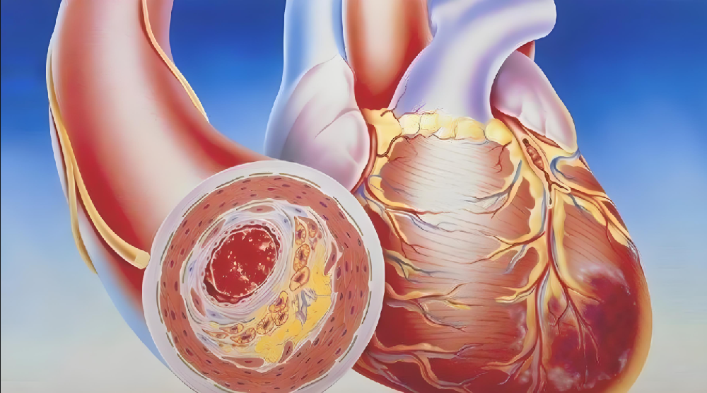 Beware of Blood Clots: Recognizing Signals and Emergency Action Guide